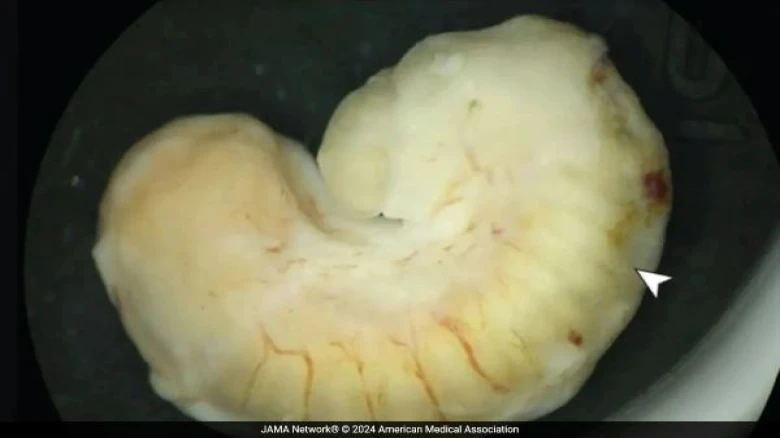 Woman Lived with Snake-like Parasite in Eye for two years after eating Crocodile Meat