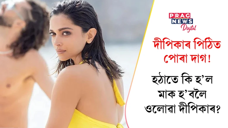 দীপিকাৰ পিঠিত পোৰা দাগ!  হঠাতে  কি হ'ল মাক হ'বলৈ ওলোৱা দীপিকাৰ?