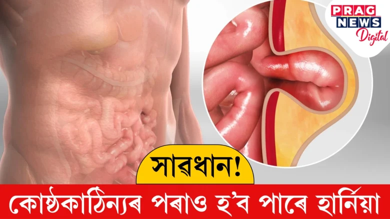 সাৱধান! কোষ্ঠকাঠিন্যৰ পৰাও হ’ব পাৰে হাৰ্নিয়া